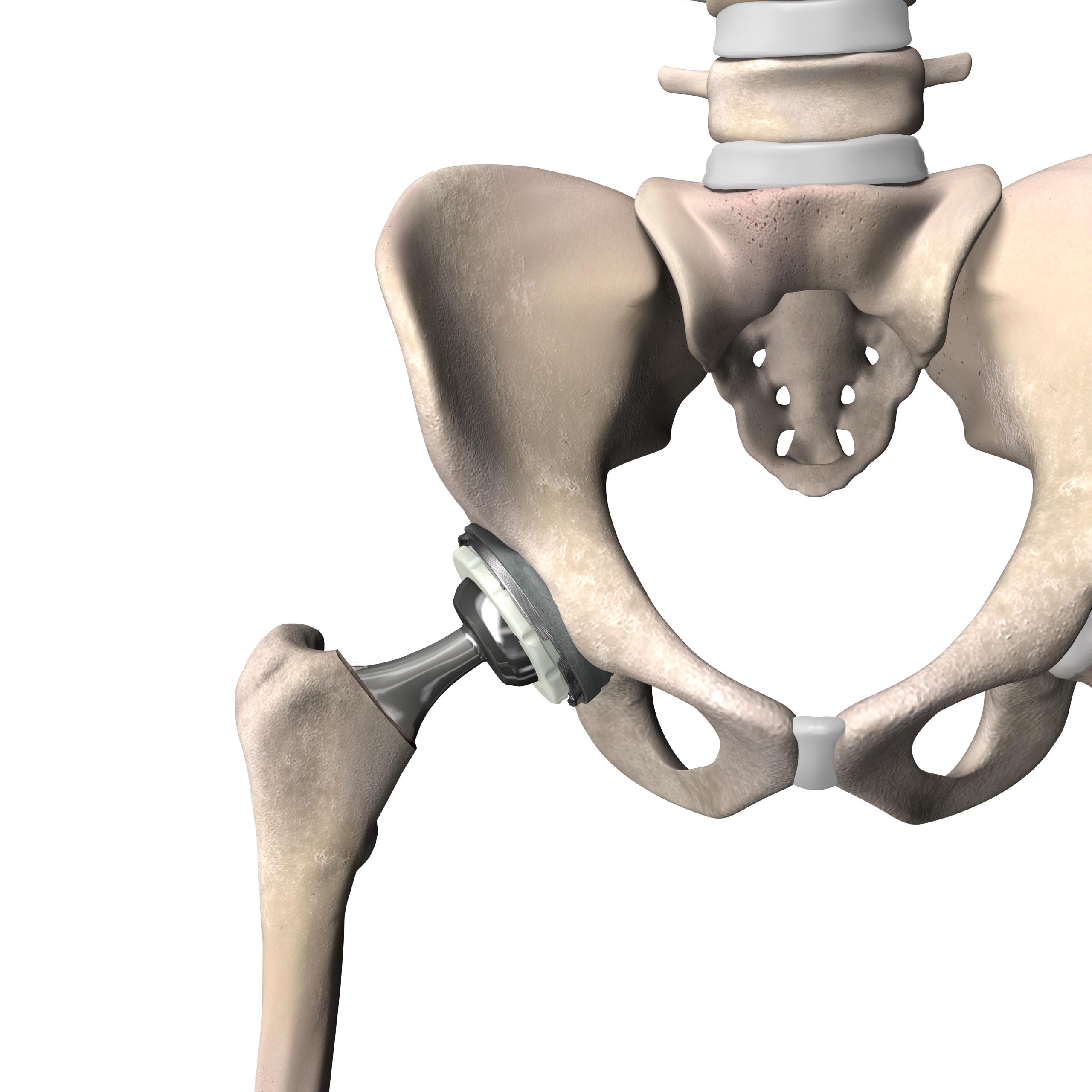 Hip Implanted