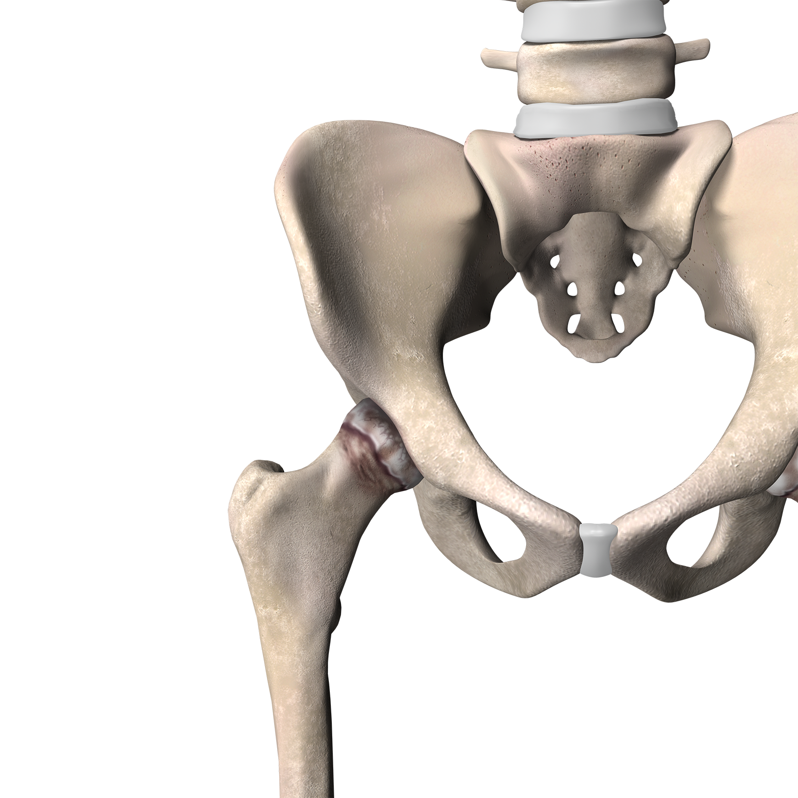 Hip_Diseased Hip Diseased