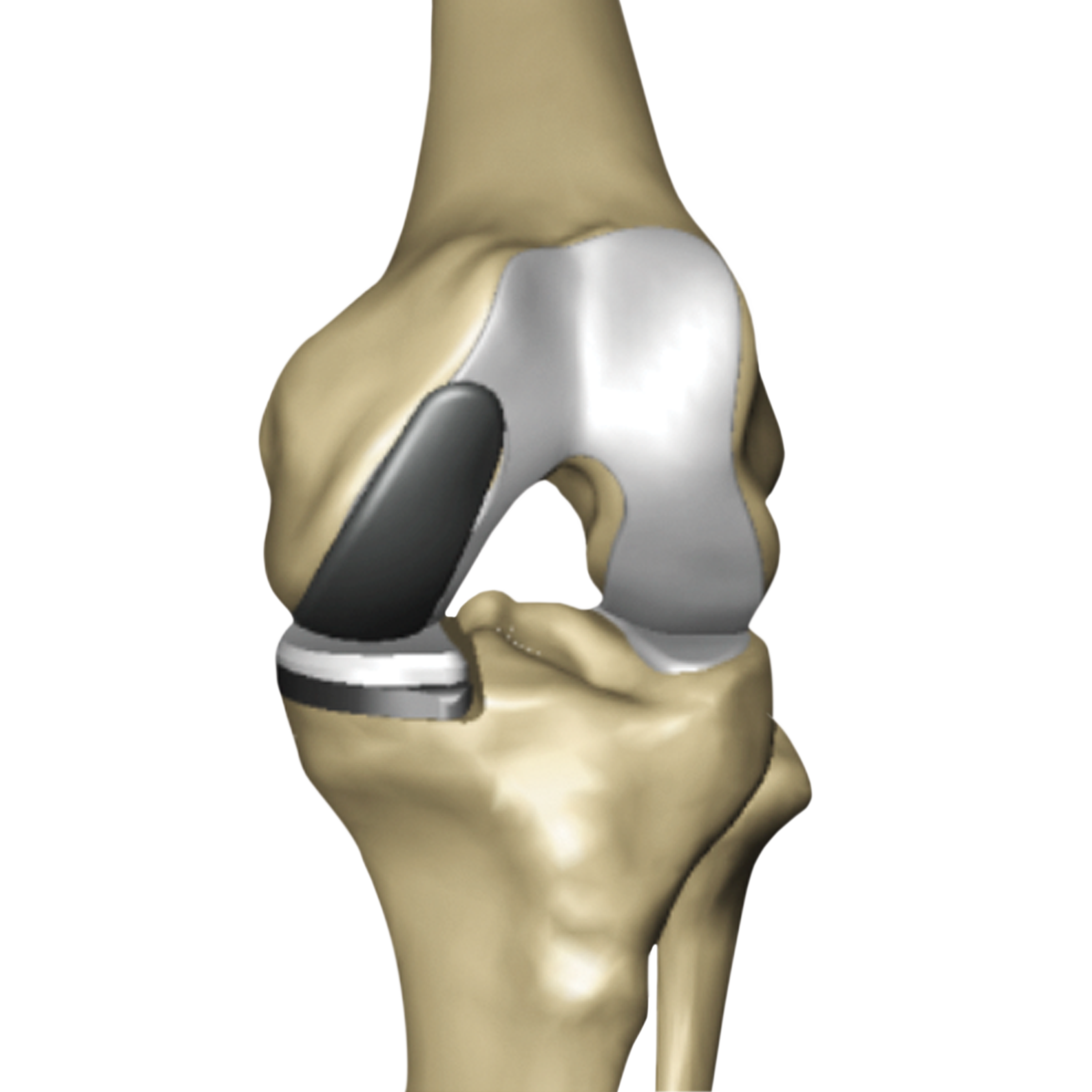 Partial Knee Implanted